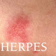 Illustration for article titled obat herpes di bibir